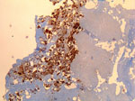 Thumbnail of Immunohistochemical detection of Coxiella burnetii in resected cardiac valve of a 60-year-old man with Q fever endocarditis, Cayenne, French Guiana. Monoclonal antibody against C. burnetii and hematoxylin were used for staining. Original magnification ×50.