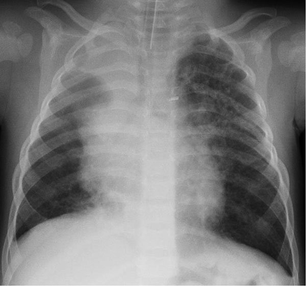 Chest radiograph of the index patient, a 16-month-old boy in Finland with human bocavirus 1 pneumonia, on day 2 of hospitalization. Bilateral pulmonary infiltrations and atelectasis of the upper right lobe can be seen.