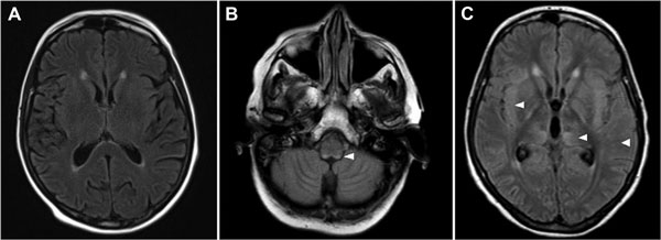 Magnetic resonance imaging axial flair sequence of brain of 66-year-old woman with fatal encephalitis, Bordeaux, France, 2012. A) No hypersignal at day 6. B) Bilateral posterior hypersignals in the medulla at day 13. C) Bilateral supratentorial hypersignals in the cortex at day 24, the white matter, and the basal ganglia. Hypersignals are indicated by white arrowheads.