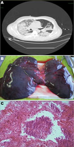 Thumbnail of A) Computed tomographic image of the chest of a 74-year-old patient (patient 1) with fatal hemorrhagic pneumonia, Catania, Italy, showing multifocal confluent parenchymal opacities. B) Postmortem view of the lungs showing hemorrhage and edema. C) Microscopic evidence of necrosis and bacteria in the lungs (original magnification ×40).
