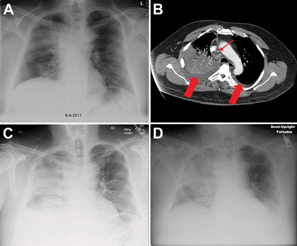 Chest x-ray and computed tomographic scan images for a patient with inhalation anthrax, Minnesota, USA. A) On hospital day 1, the x-ray image revealed a right upper lobe infiltrate and widening of the mediastinum. B) On hospital day 2, computed tomographic scan of the chest with intravenous contrast showed dense consolidation of the right upper lobe, mediastinal adenopathy (small arrow), and bilateral pleural effusions (large arrows). C) By hospital day 4, progressive infiltrates in the right lu