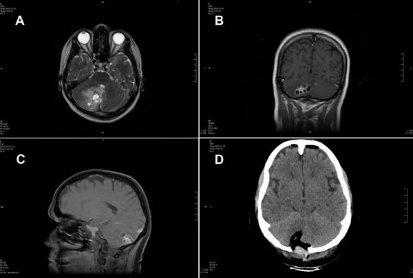 Magnetic resonance (MR) and computed tomographic images of the brain of a 51-year-old woman infected with Taenia crassiceps tapeworm larvae, Germany. A) Transverse view, T1-weighted MR image. The 30 × 30 mm parasitic lesion with perifocal edema is located in the right hemisphere of the cerebellum and caused ataxia, headache, and nausea. The fourth ventricle is compressed. B) Coronal view, T2-weighted MR image. The cyst-like appearance of the parasitic tissue is clearly visible. This lesion can b