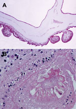 Thumbnail of Histologic section through Taenia crassiceps tapeworm larvae removed from the cerebellum of a 51-year-old woman, Germany. A) Section through parasite body showing multiple connected bladders (asexual buddings) at the caudal end. Original magnification ×20. B) Transverse section through the parasite’s protoscolex showing numerous hooklets, similar to T. solium tapeworm larvae. Original magnification ×40. Like the Taenia solium tapeworm that causes cysticercosis, and in contrast to di