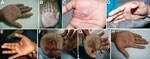 Thumbnail of Progression of lesion on palm of researcher caused by buffalopox virus infection, India. A) Small vesicle on postinjury day 5. B) Pustule with a central area of necrosis on postinjury day 7. C) Pustule with edema on postinjury day 9. D) Increase in edema on postinjury day 10 (cyanosis is not apparent). E) Lesion after surgical excision on postinjury day 11. F) Lesion on postinjury day 19 (healing was erratic). G) Blackening and thickening around surgical site on postinjury day 30, w