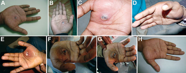 Progression of lesion on palm of researcher caused by buffalopox virus infection, India. A) Small vesicle on postinjury day 5. B) Pustule with a central area of necrosis on postinjury day 7. C) Pustule with edema on postinjury day 9. D) Increase in edema on postinjury day 10 (cyanosis is not apparent). E) Lesion after surgical excision on postinjury day 11. F) Lesion on postinjury day 19 (healing was erratic). G) Blackening and thickening around surgical site on postinjury day 30, which then ext