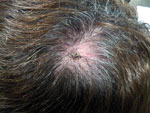 Thumbnail of Inoculation eschar surrounded by an erythematous halo at the site of a tick bite on the scalp of a female patient in Portugal. Tick-borne lymphoadenopathy caused by Rickettsia slovaca infection was later confirmed.