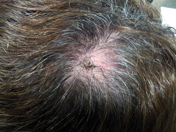 Inoculation eschar surrounded by an erythematous halo at the site of a tick bite on the scalp of a female patient in Portugal. Tick-borne lymphoadenopathy caused by Rickettsia slovaca infection was later confirmed.