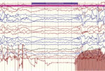 Thumbnail of Ictal electroencephalographic recording of a 12-year-old boy in Uganda with nodding syndrome obtained during a typical nodding episode. Shown is a sudden electrodecremental episode with concomitant electromyographic decrease in neck muscles, followed by sharply contoured theta activity. 