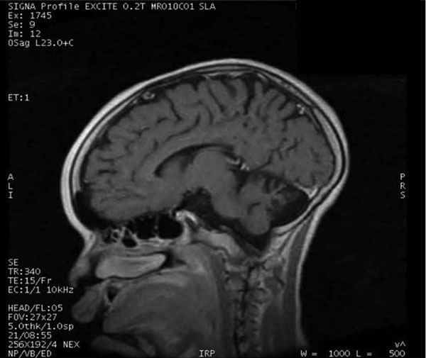 Magnetic resonance image of a 13-year-old boy in Uganda with nodding syndrome. Image shows prominent cortical atrophy.