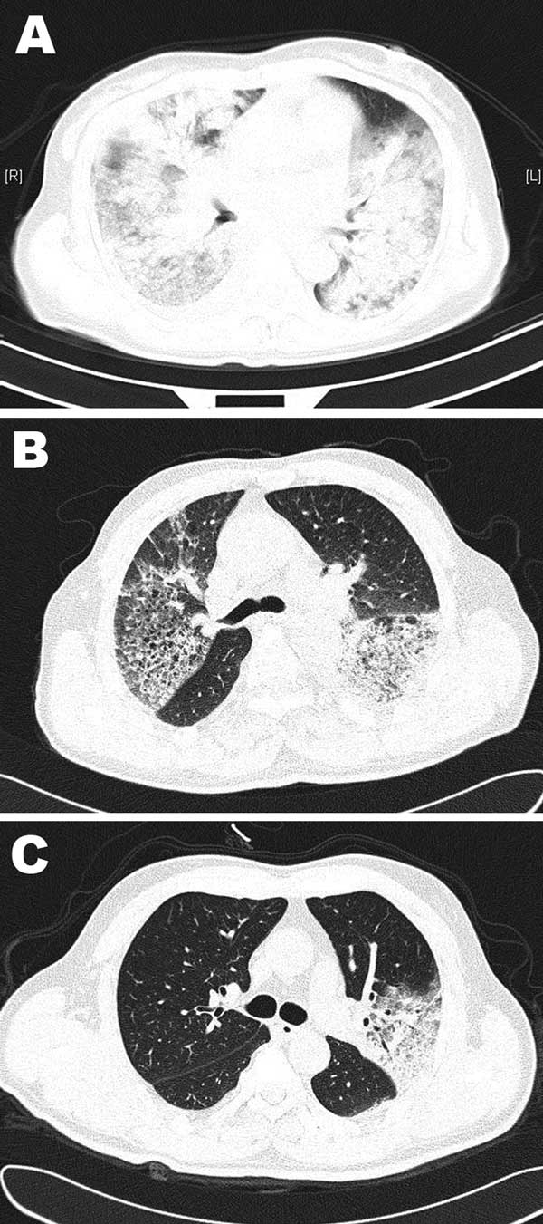 Chest computed tomographic scans for 3 patients infected with avian influenza A(H7N9) virus, Shanghai, China. A) Patient 1, who died, showing extensive lung infiltrates at day 7 of illness onset. B) Patient 3, who had a severe case, showing partial rear lung infiltrations on both sides of the lung and partial normal lung at day 7 of illness onset. C) Patient 4, who had a mild case, showing only partial left lung lobar involvement at day 9 of illness onset.