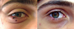 Thumbnail of Palpebral eschars caused by Rickettsia sibirica mongolitimonae infection in a 16-year-old febrile boy with fever, southern France, spring, 2012 (left). He recovered after doxycycline treatment (right).