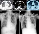 Thumbnail of Chest computed tomography (CT) scan and radiograph images of patient (case-patient 1) in a study of 4 persons with early cases of influenza A(H7N9) virus infection, Shanghai, China. Images were taken 1, 5, 7, and 11 days after illness onset. A, B) CT scan images on day 1, showing bilateral pleural effusion but no obvious lesions. C) CT scan image on day 5, showing extensive ground-glass opacity and consolidation. D, E) x-ray images on days 7 and 11, respectively, showing reduced lig