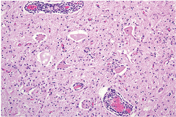 Spinal cord at the L5 segment of a heifer with encephalomyelitis (animal 2). Note the nonsuppurative encephalomyelitis with lymphocytic perivascular cuffs, neuronal degeneration and necrosis, spheroids from necrotic neurons, and neuronophagia with widespread microgliosis. Hematoxylin and eosin stain. Original magnification ×400.