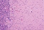 Thumbnail of Dorsal root ganglion of a heifer with encephalomyelitis (animal 2). Multifocal marked interstitial lymphocyte, macrophage, and plasma cell infiltrates with multifocal neuronal degeneration and necrosis can be seen. Hematoxylin and eosin stain. Original magnification ×400.