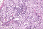 Thumbnail of Cerebellum of a yearling steer with encephalomyelitis (animal 1). Note the selective extensive acute necrosis and degeneration of Purkinje cells. Numerous necrotic dendritic spheroids in the molecular layer with a cellular proliferation of Bergmann glia and of microgliosis. Hematoxylin and eosin stain. Original magnification ×400.