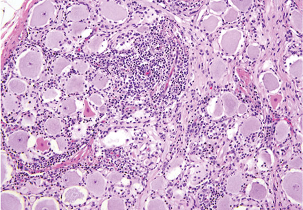 Cerebellum of a yearling steer with encephalomyelitis (animal 1). Note the selective extensive acute necrosis and degeneration of Purkinje cells. Numerous necrotic dendritic spheroids in the molecular layer with a cellular proliferation of Bergmann glia and of microgliosis. Hematoxylin and eosin stain. Original magnification ×400.