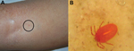 Thumbnail of Clinical features of a nonspecific lesion (A) and its corresponding, unequivocal dermoscopy findings (B), showing a Neotrombicula autumnalis mite attached to the skin (magnification ×150).