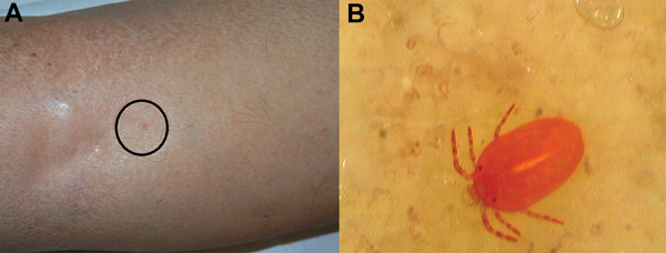 Clinical features of a nonspecific lesion (A) and its corresponding, unequivocal dermoscopy findings (B), showing a Neotrombicula autumnalis mite attached to the skin (magnification ×150).