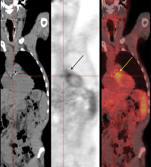Positron emission tomography/computed tomography fusion imaging for a 56-year-old man in southern France with Bartonella henselae prosthetic valve endocarditis. Left panel, frontal computed tomography image showing morphologic findings. Middle panel, 18F-fluorodeoxyglucose positron emission tomography (18FDG-PET) showing a cardiac hotspot (arrow) in relation to abnormal uptake of 18FDG. Right panel, fusion image combining 18F-FDG-PET and computed tomography showing localization of an aortic valv