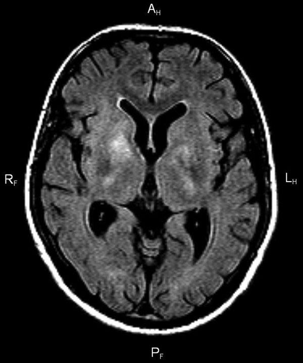Fluid-attenuated inversion recovery magnetic resonance imaging of the brain of a 38-year-old man with tick-borne encephalitis and chorea. The image shows bilateral areas of hyperintensity in T2, affecting the nucleus caudate, internal capsule, and thalami.