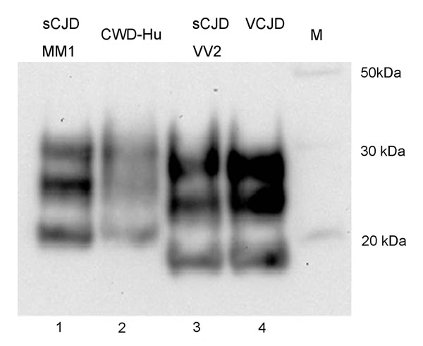 PrPres typing of the CWD amplification product. The CWD PMCA product derived from amplification in a human brain homogenate substrate (PRNP codon 129MM) was compared by Western blotting with PrPres from human brain samples from cases of sCJD of the MM1 subtype, sCJD of the VV2 subtype, and variant CJD. The PrP detection antibody was 3F4. PrPres, protease-resistant prion protein; CWD, chronic wasting disease; PMCA, protein misfolding cyclic amplification; sCJD sporadic Creutzfeldt-Jakob disease; 