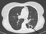 Thumbnail of Computed tomography scan showing a cavity (arrow) in the left lung of a 74-year-old woman (patient 1) in Italy. Laboratory testing suggests that the woman was infected with Mycobacterium yongonense.
