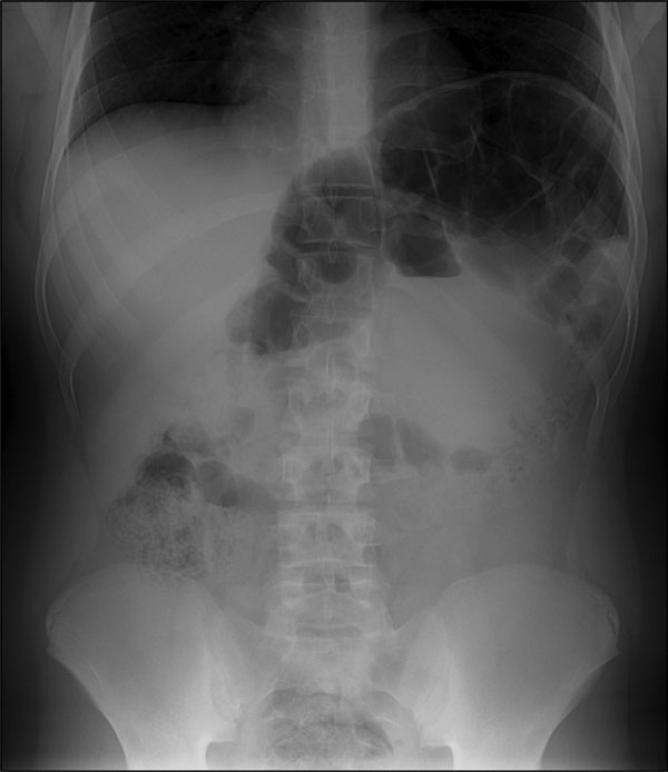 Abdominal radiograph of a 13-year-old boy with congenital Chagas disease, Japan, showing megacolon and marked dilatation at the splenic flexure.