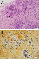 Thumbnail of Light micrographs of muscle biopsy tissue from a 67-year-old man (case-patient A), New South Wales, Australia, showing microsporidial myositis caused by Anncaliia algerae. A) Necrotizing myositis with prominent inflammation and spores within the necrotic cytoplasm of a myocyte (arrow). Hematoxylin and eosin stain. Scale bar indicates 50 μm. B) Numerous dark brown to black, 3- to 4-μm ovoid spores in necrotic myocytes. Warthin-Starry stain. Scale bar indicates 20 μm.