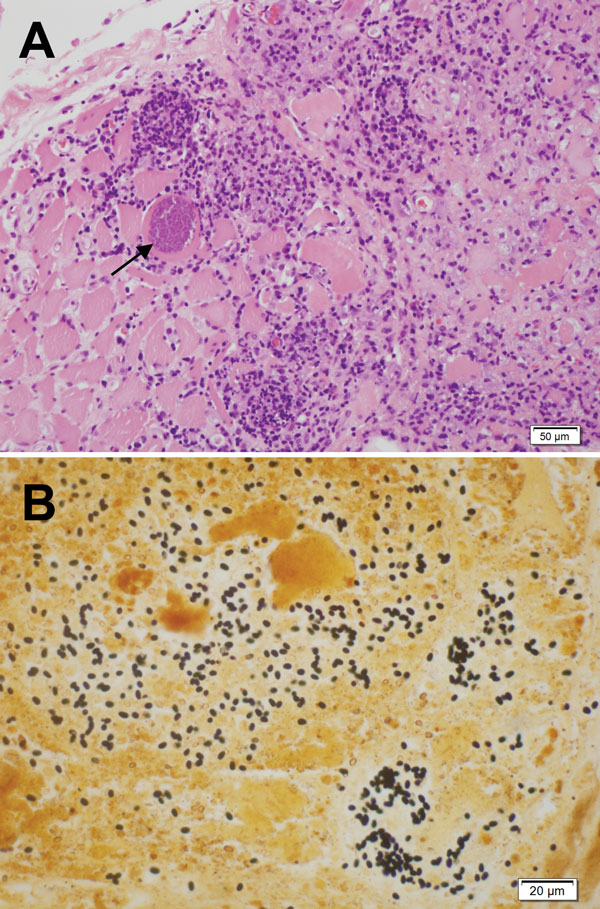 Light micrographs of muscle biopsy tissue from a 67-year-old man (case-patient A), New South Wales, Australia, showing microsporidial myositis caused by Anncaliia algerae. A) Necrotizing myositis with prominent inflammation and spores within the necrotic cytoplasm of a myocyte (arrow). Hematoxylin and eosin stain. Scale bar indicates 50 μm. B) Numerous dark brown to black, 3- to 4-μm ovoid spores in necrotic myocytes. Warthin-Starry stain. Scale bar indicates 20 μm.