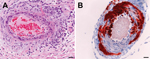 Thumbnail of Histologic and immunohistologic findings in Hendra virus–infected horse tissue. A) hematoxylin and eosin staining shows systemic vasculitis affecting the lung. B) Immunohistologic examination, using polyclonal rabbit anti-Nipah N protein, indicates Hendra virus antigen in a blood vessel in the brain. Scale bar represent 50 μm.