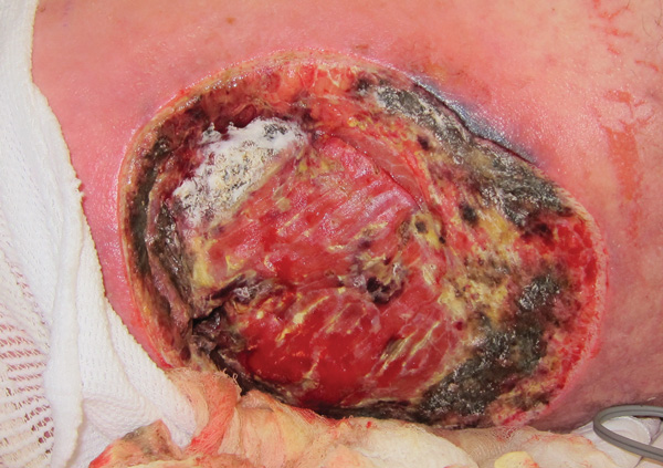 Necrotizing cutaneous mucormycosis, Joplin, Missouri, USA, 2011 (4). A left flank wound in a mucormycosis case-patient, with macroscopical fungal growth (tissue with white, fluffy appearance) and necrotic borders before repeated surgical debridement. Copyright 2012 Massachusetts Medical Society. Reprinted with permission.
