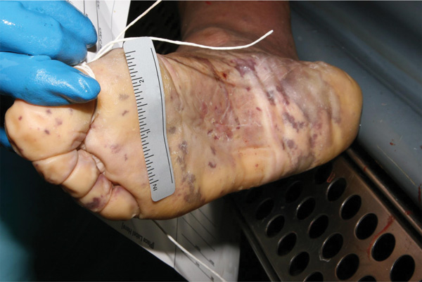 Postmortem purpuric rash on sole of a man for whom invasive meningococcal disease was diagnosed after death (case 1), New York City, New York, USA.