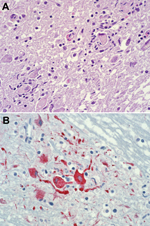 Thumbnail of Photomicrographs showing histopathologic features and immunolocalization of West Nile virus antigens in central nervous system tissue from a kidney transplant recipient with transplant-transmitted West Nile virus infection. A) Central nervous system showing mononuclear inflammation, gliosis, and neuronophagia. Hematoxylin and eosin staining. Original magnification, ×125. B) West Nile virus antigens within neurons and neuronal processes. Immunoalkaline phosphate staining, naphthol fa