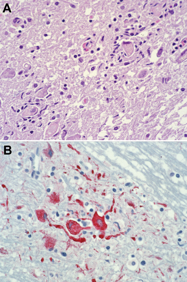 Photomicrographs showing histopathologic features and immunolocalization of West Nile virus antigens in central nervous system tissue from a kidney transplant recipient with transplant-transmitted West Nile virus infection. A) Central nervous system showing mononuclear inflammation, gliosis, and neuronophagia. Hematoxylin and eosin staining. Original magnification, ×125. B) West Nile virus antigens within neurons and neuronal processes. Immunoalkaline phosphate staining, naphthol fast red substr