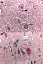 Thumbnail of Photomicrographs showing histopathologic features and immunolocalization of rabies virus antigens in central nervous system tissue from a kidney transplant recipient with donor-derived rabies infection. A. Typical intracytoplasmic eosinophilic inclusions (Negri bodies, arrows). Hematoxylin and eosin staining. Original magnification, ×158. B) Rabies virus antigens within neurons and neuronal processes. Immunoalkaline phosphate staining, naphthol fast red substrate with light hematoxy