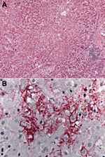 Thumbnail of Photomicrographs showing histopathologic features and immunolocalization of lymphocytic choriomeningitis virus (LCMV) antigens in liver tissue from a liver transplant recipient with donor-derived LCMV infection. A) Massive hepatic necrosis, without prominent inflammation. Hematoxylin and eosin staining. Original magnification, ×50. B) LCMV antigens within hepatocytes and sinusoidal lining cells. Immunoalkaline phosphate staining, naphthol fast red substrate with light hematoxylin co