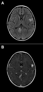 Thumbnail of Brain images showing contrast-enhanced lesions in the right occipital and left parietal lobes of a 4-year-old boy with encephalitis caused by infection with Balamuthia mandrillaris amebae. A) T2-weighted fluid-attenuated inversion recovery (FLAIR) image. B) T1-weighted contrasted magnetic resonance image.