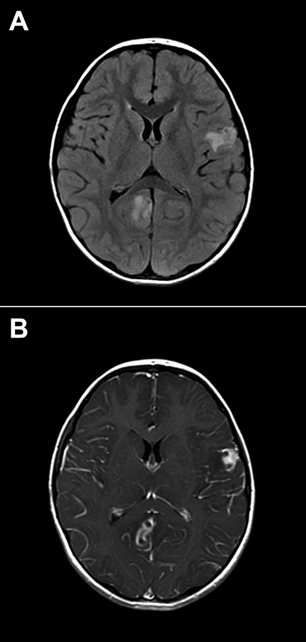 Brain images showing contrast-enhanced lesions in the right occipital and left parietal lobes of a 4-year-old boy with encephalitis caused by infection with Balamuthia mandrillaris amebae. A) T2-weighted fluid-attenuated inversion recovery (FLAIR) image. B) T1-weighted contrasted magnetic resonance image.