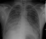 Thumbnail of Chest radiograph of 40-year-old man with acute respiratory distress syndrome as a complication of murine typhus.