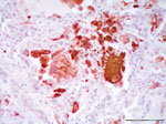 Thumbnail of Lung from necropsy of a bottlenose dolphin (Tursiops truncatus) that had fatal systemic morbillivirus infection, Canary Islands, Spain, 2005. Positive intracytoplasmic and intranuclear immunoperoxidase staining of morbilliviral antigen (red) within hyperplastic type II pneumocytes, macrophages and multinucleated syncytial cells. Avidin-biotin-peroxidase with Harris hematoxylin counterstain. Scale bar = 100 μm.