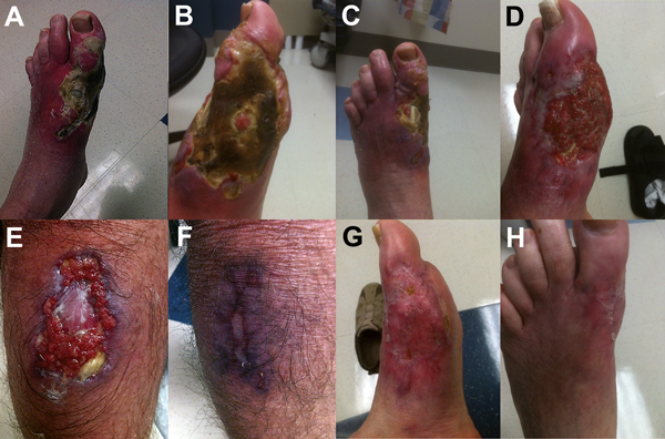 Progression of lesions caused by Mycobacterium ulcerans infection before, during, and after treatment. A–C) Left foot before treatment. D) Left lower leg during treatment. E) Right calf before treatment. F) Right calf after treatment. G, H) Left foot after treatment.
