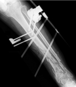 Thumbnail of Radiograph of left leg of patient with Clostridium tetani infection, showing delayed bone consolidation 11 months after fracture.