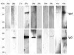 Thumbnail of Western blot reactivity to recombinant Borrelia miyamotoi glycerophosphodiester phosphodiesterase in serum samples from 5 Borrelia miyamotoi sensu lato–seropositive patients in the northeastern United States, 1991–2012. Numbers at the top of rows are patient numbers and correspond to patients 26–29 and 45 in (Table 1). The letters a and c that follow patient numbers indicate acute- and convalescent-phase serum samples, respectively. Western blot results that show no seroreacti