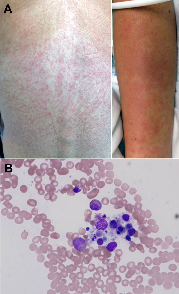 A) Maculopapular eruption observed on the back and arms of 25-year-old female wildlife biologist infected with a novel paramyxovirus related to rubula-like viruses isolated from fruit bats, on hospitalization day 2. B) Bone marrow biopsy sample showing macrocytic hemophagocytosis (possible granulocyte infiltration).