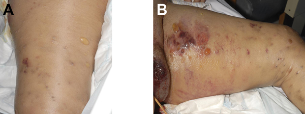 Manifestation of heroin-associated anthrax in patient 1, who injected heroin under the skin of her left thigh. Panel A demonstrates substantial edema and blistering of skin. Manifestation is more pronounced in Panel B, which demonstrates more blistering and bruising.