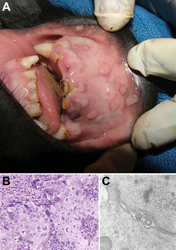 Vesicular stomatitis in a wild-caught juvenile Grauer’s gorilla (Gorilla beringei graueri). Gross lesions, histopathologic examination, transmission electron microscopy, and molecular screening confirmed human herpesvirus type 1 (HSV-1) as the etiologic agent. A) Human HSV-1 lip lesions in a wild-caught juvenile Grauer’s gorilla. B) Section of oral mucosa adjacent to a vesiculo-ulcerative lesion exhibits epithelial cell necrosis, cytoplasmic swelling, nuclear chromatin margination (sometimes wit