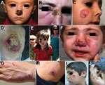 Thumbnail of Patterns of leishmaniasis among Syrian refugees in Lebanon, 2012. A,B) Lesions impinging and possibly hindering the function of vital sensory organs, including the nose and eyes. C,D) Lesions &gt;5 cm.E,F) Lesions disfiguring the face. G,H) Special forms of cutaneous leishmaniasis; shown here is a patient with spread and satellite lesions on the hand and arm. I,J) Patient with 15 lesions.