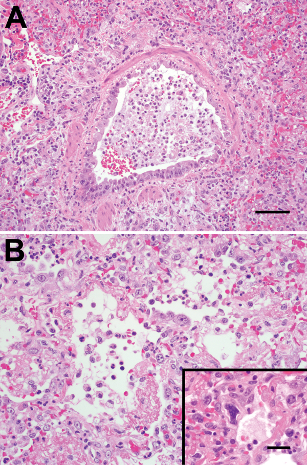 A) Bronchiolar epithelium of chimpanzees infected with human metapneumovirus, United States, 2009, showing cell variation from attenuated to piled and disorganized. Epithelial cells lack cilia, and lumens contain foamy macrophages, neutrophils, and hemorrhage. Adjacent air spaces are filled with similar inflammatory cells. Scale bar = 70 μm. B) Alveoli lined with plump type II pneumocytes and fibrin. Inset: Rare, deeply basophilic, smudged nuclei are present in some areas. Scale bar = 20 μm. (He