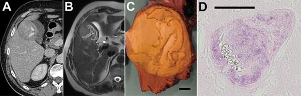 Results of testing in a 63-year-old man from the Jura département (eastern France), who was diagnosed with infection with Echinococcus ortleppi larval tapeworms in 2001. A) Abdominal computed tomography scan; B) magnetic resonance imaging; and C) macroscopic morphologic examination of operative specimen. All show lesions with a detached endocyst and calcified matrix; scale bar in panel C indicates 1 cm. D) Microscopic examination  shows evidence of protoscoleces in the matrix (hematoxylin and eo