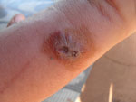 Thumbnail of Lesion on arm of a human who worked as a milker, São Paulo State, Brazil. The lesion was determined to be caused by infection with vaccinia virus.